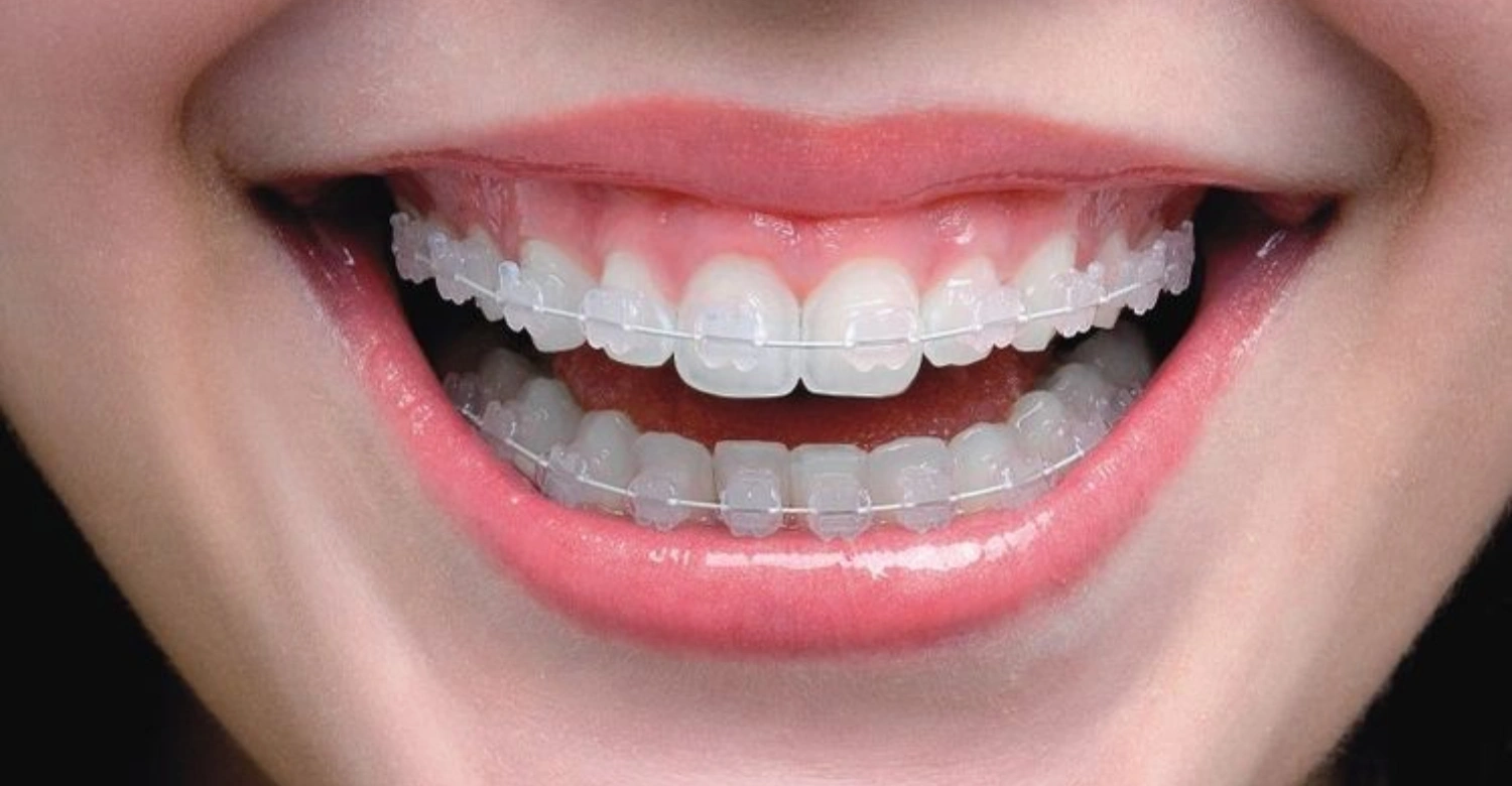 Ceramic Braces1